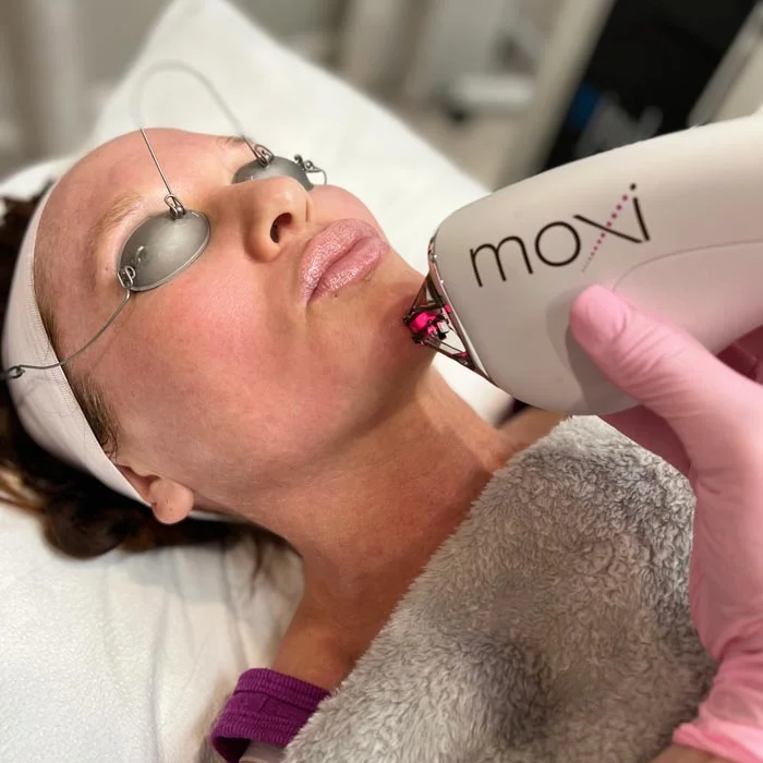 MOXI® Laser Treatments