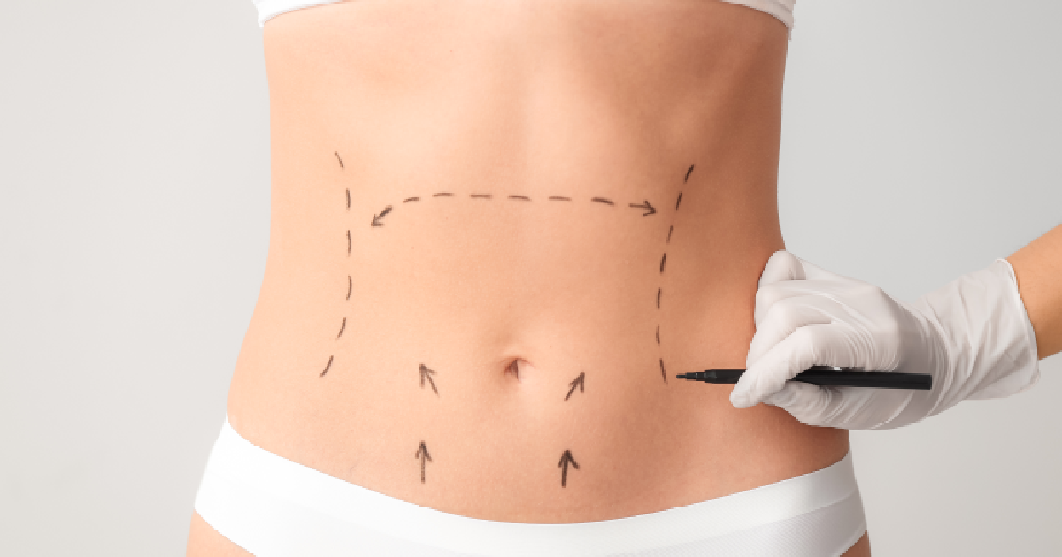 Abdominoplasty