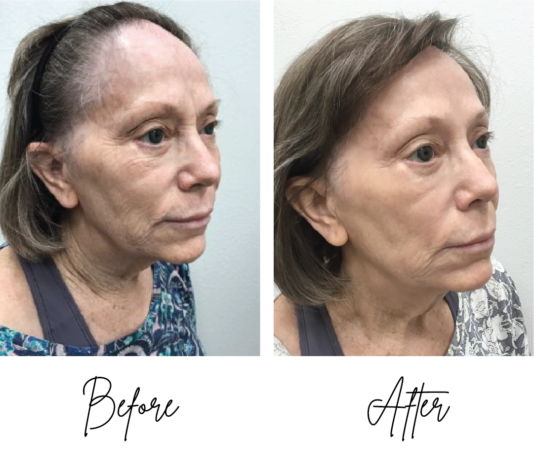 Before-after CO2 patient 3