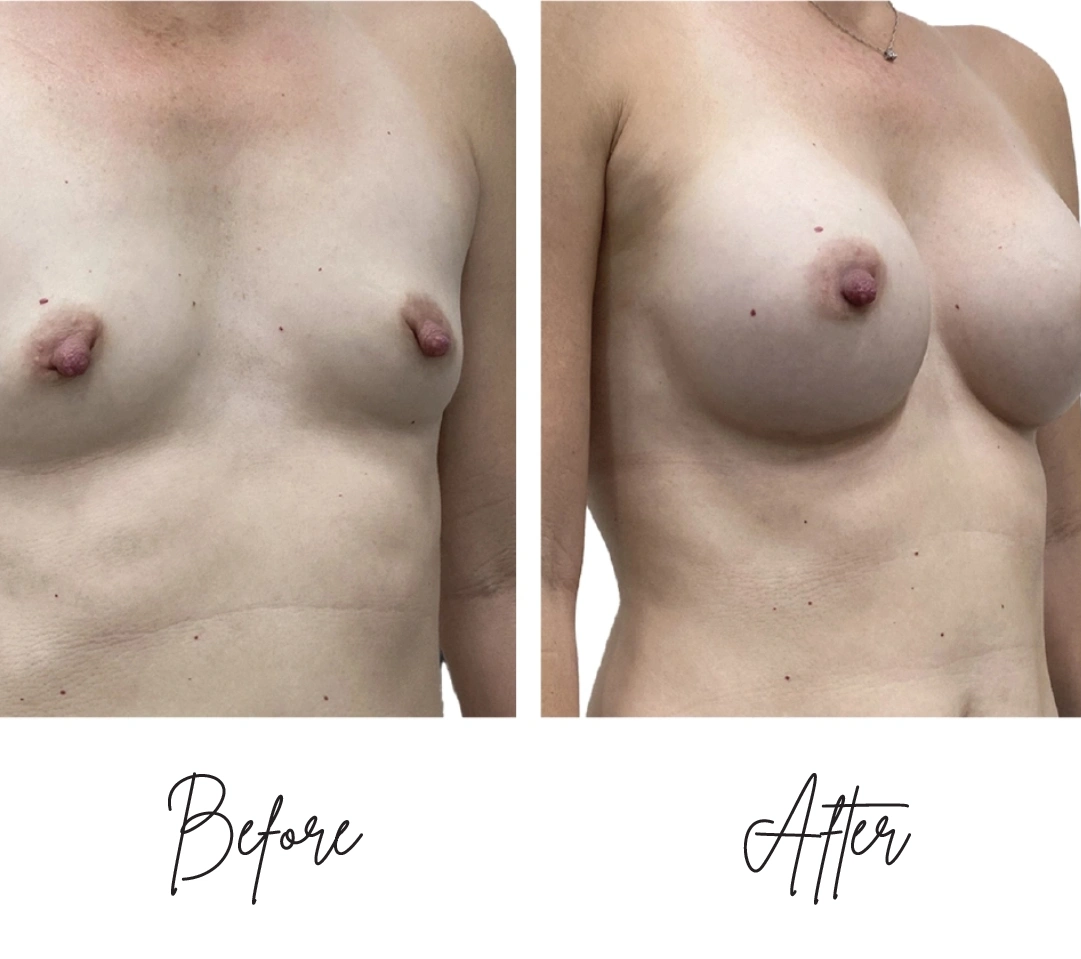 Breast augmentation four