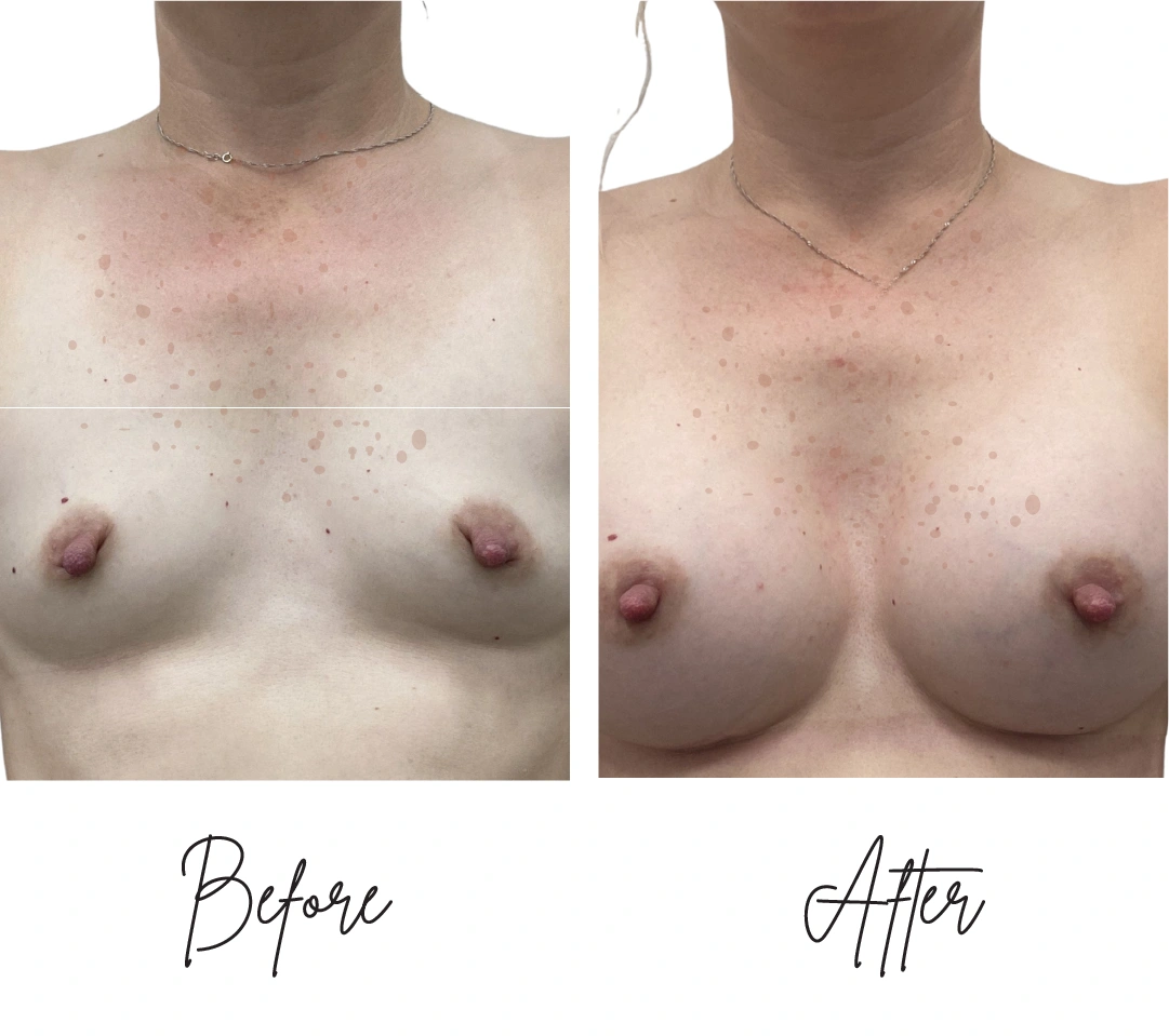 Breast augmentation one