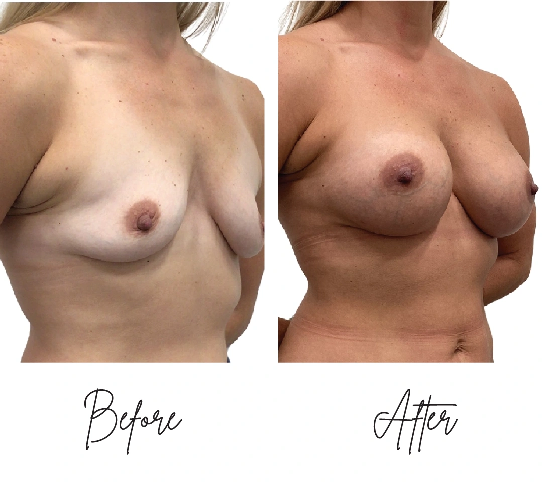 Breast augmentation three