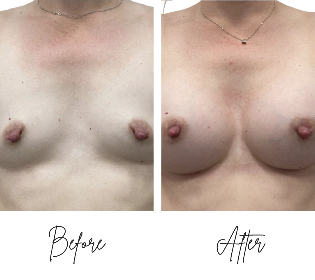 Breast augmentation two