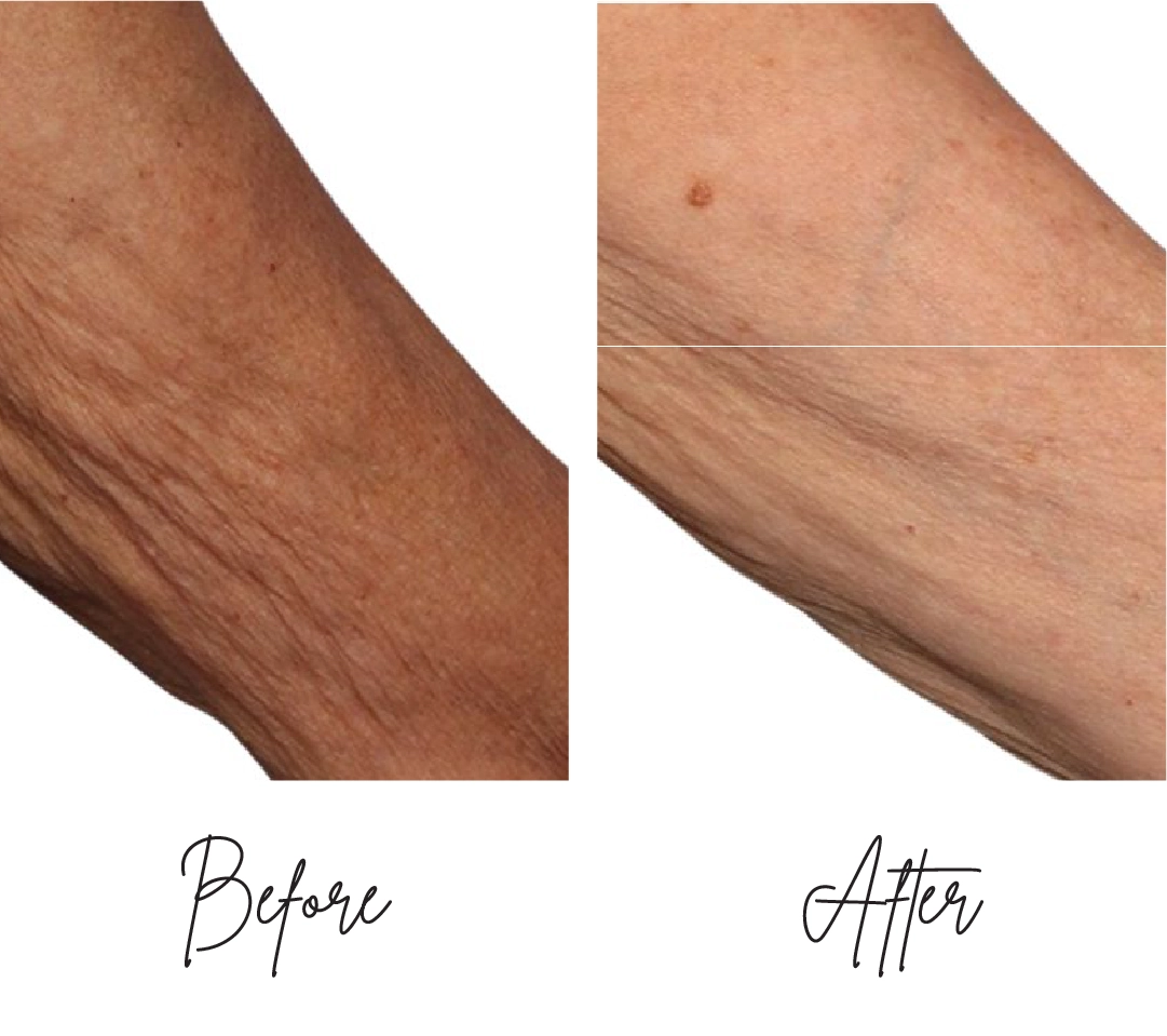 Morpheus8-Before-After-a