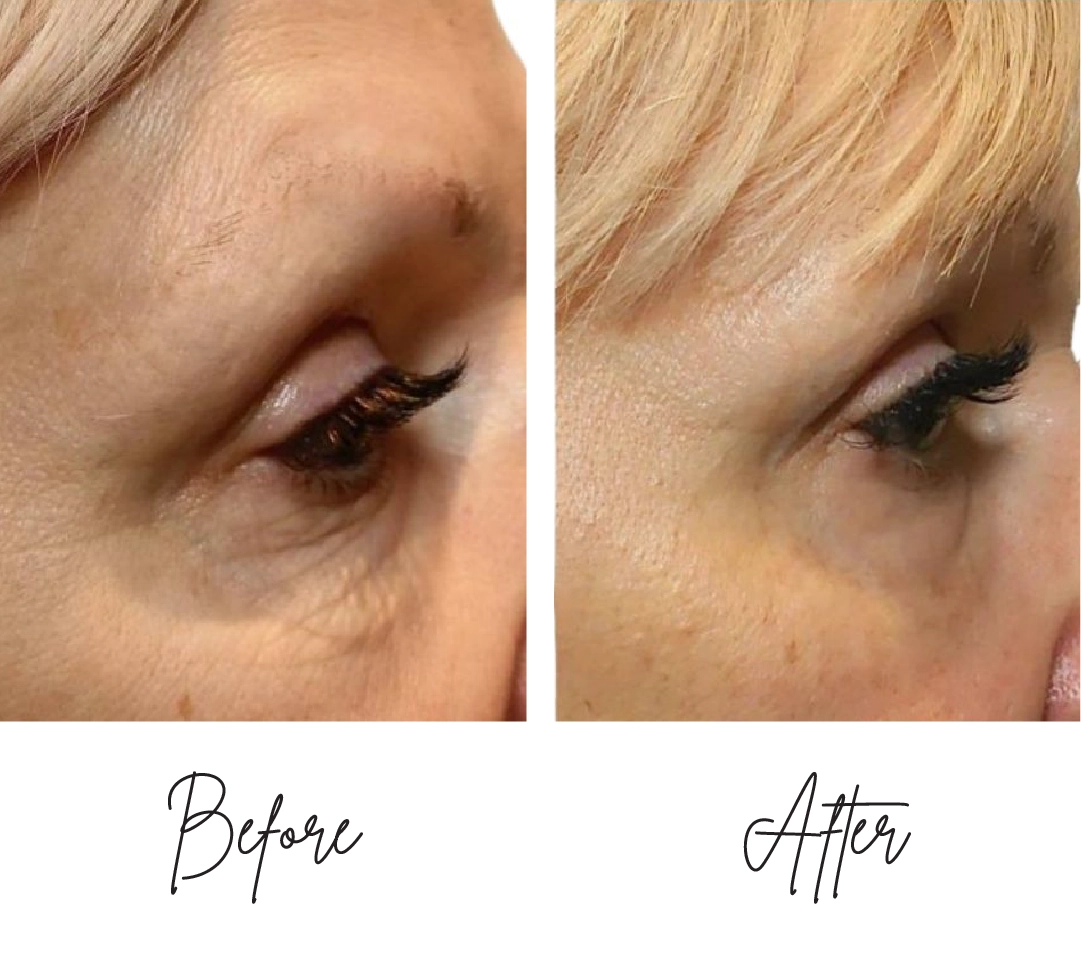 Morpheus8-Before-After-b