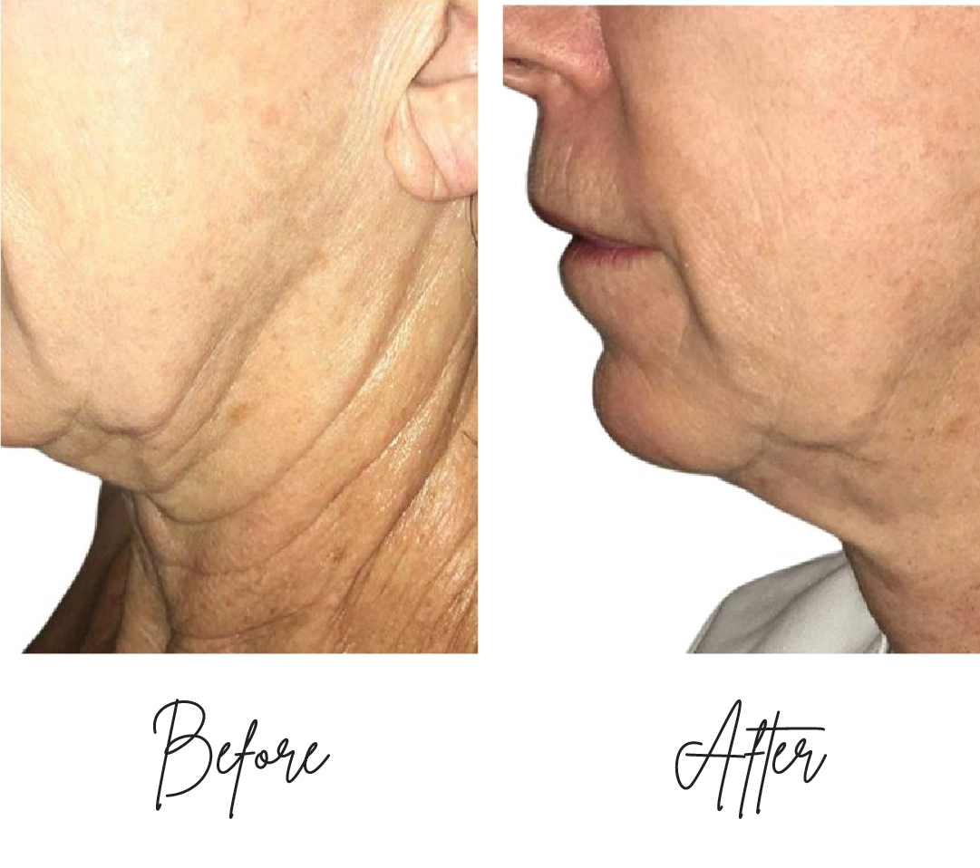 Morpheus8-Before-After-c