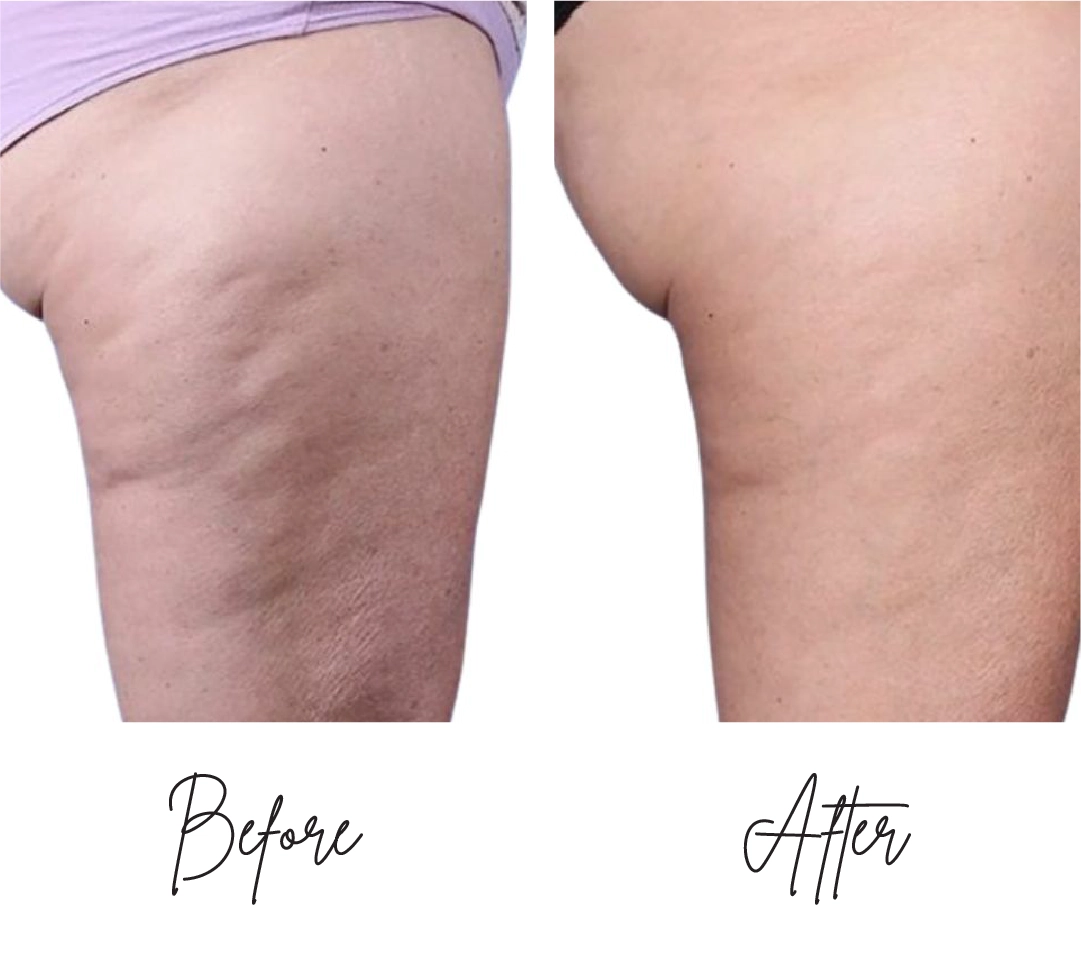 Morpheus8-Before-After-d