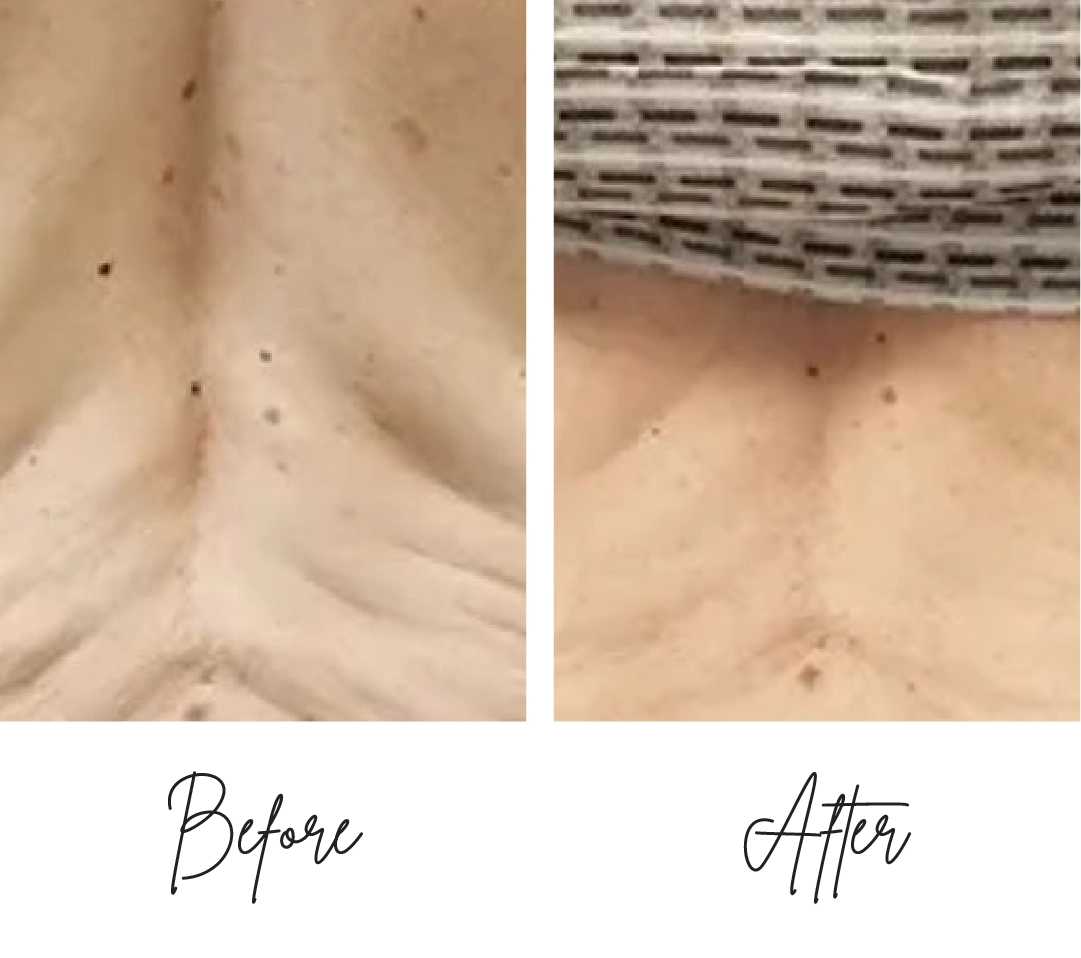 Morpheus8-Before-After-f