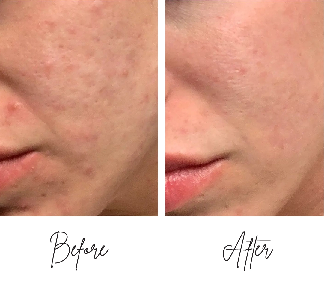 Morpheus8-Before-After-h