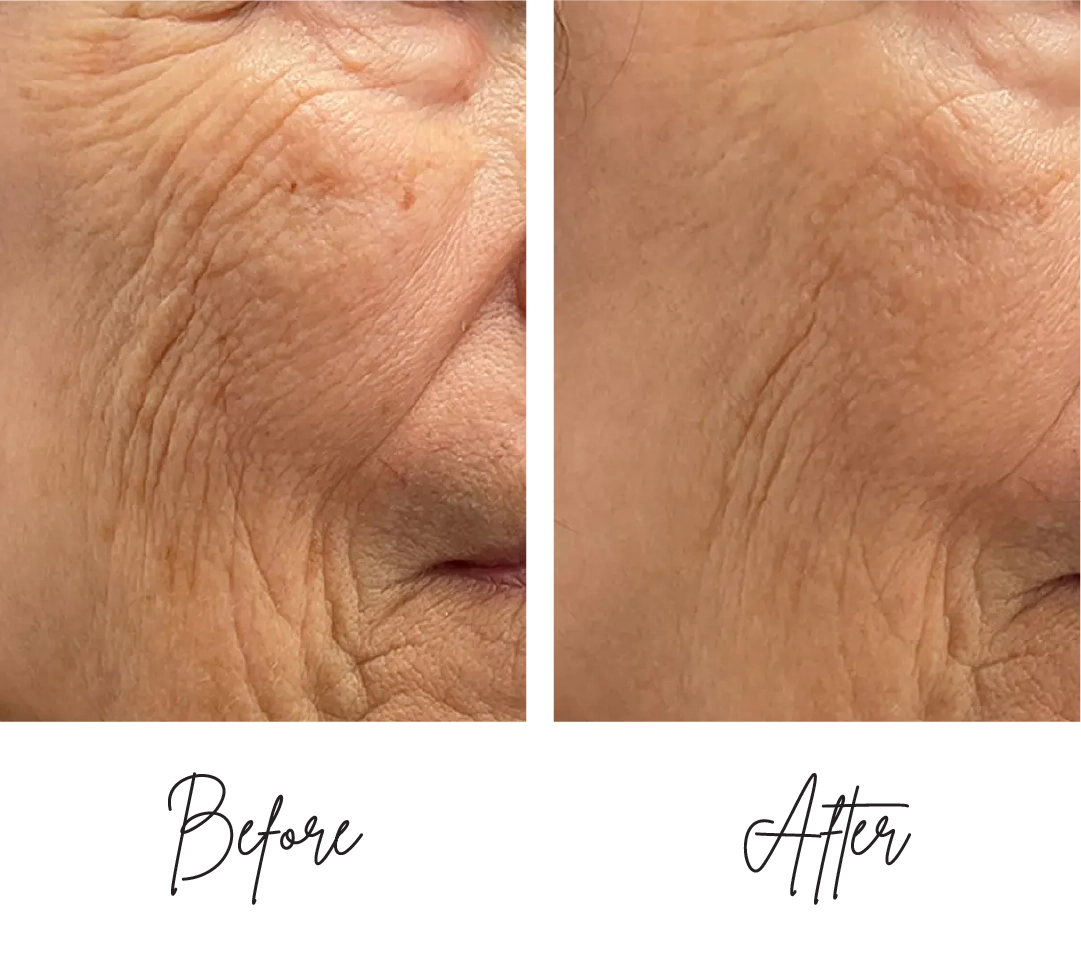 Morpheus8-Before-After-i