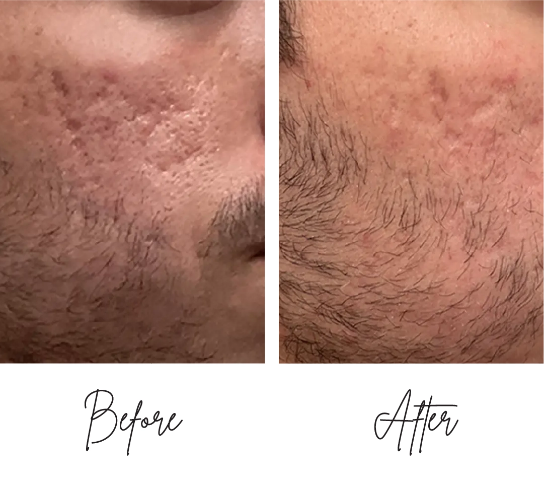 Morpheus8-Before-After-j