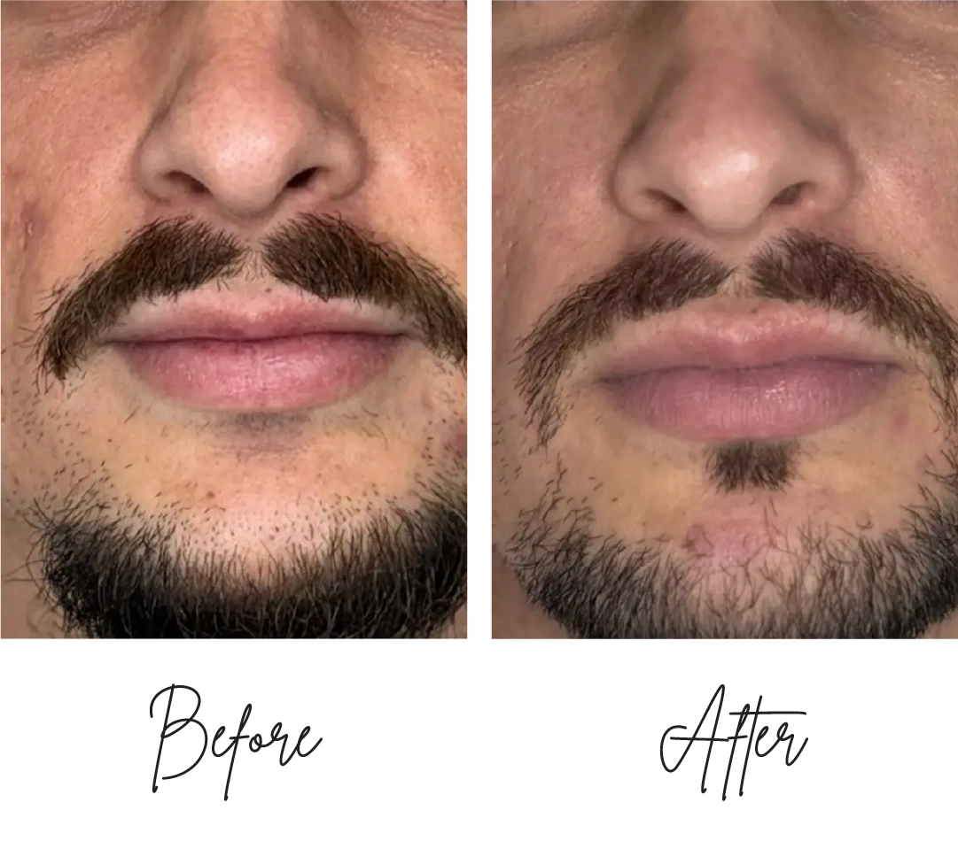 Morpheus8-Before-After-k