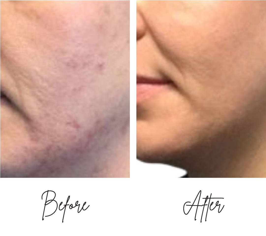 Morpheus8-Before-After-o