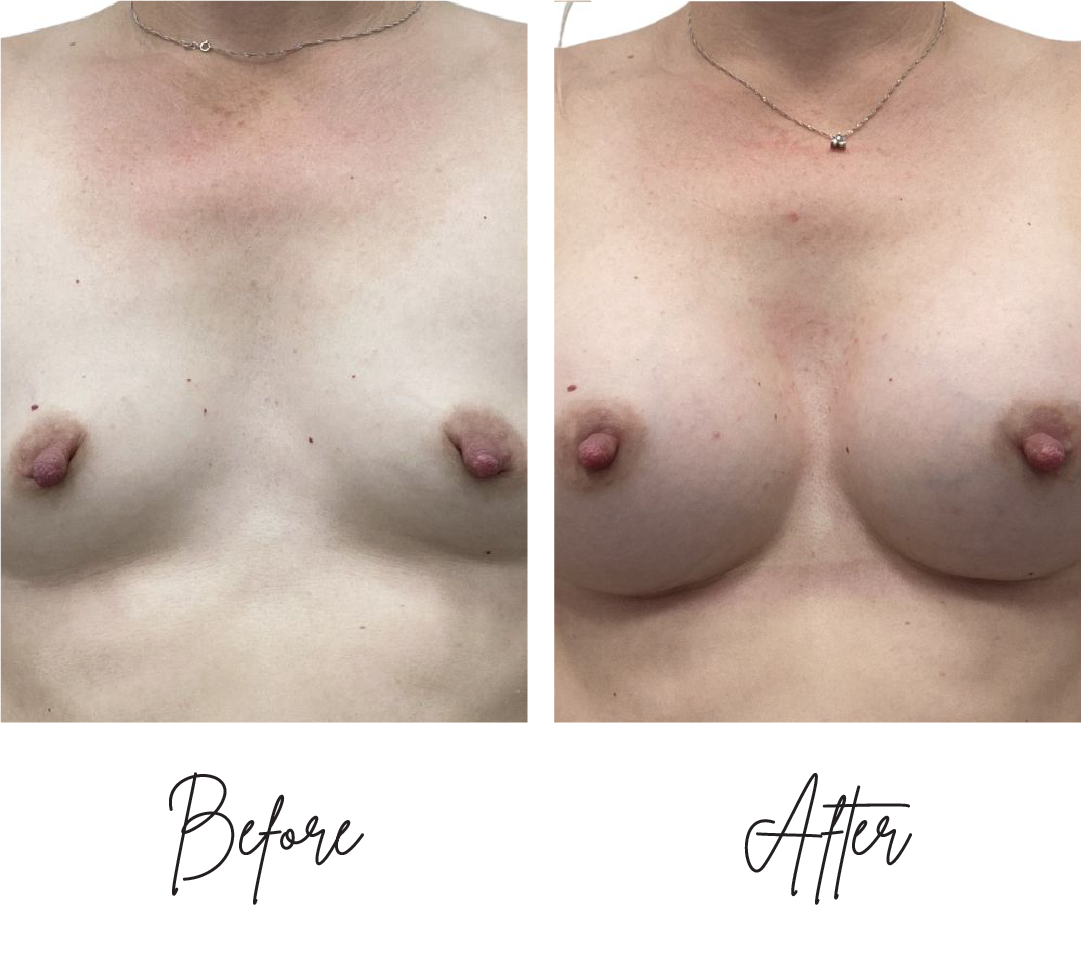 breast-augmentation