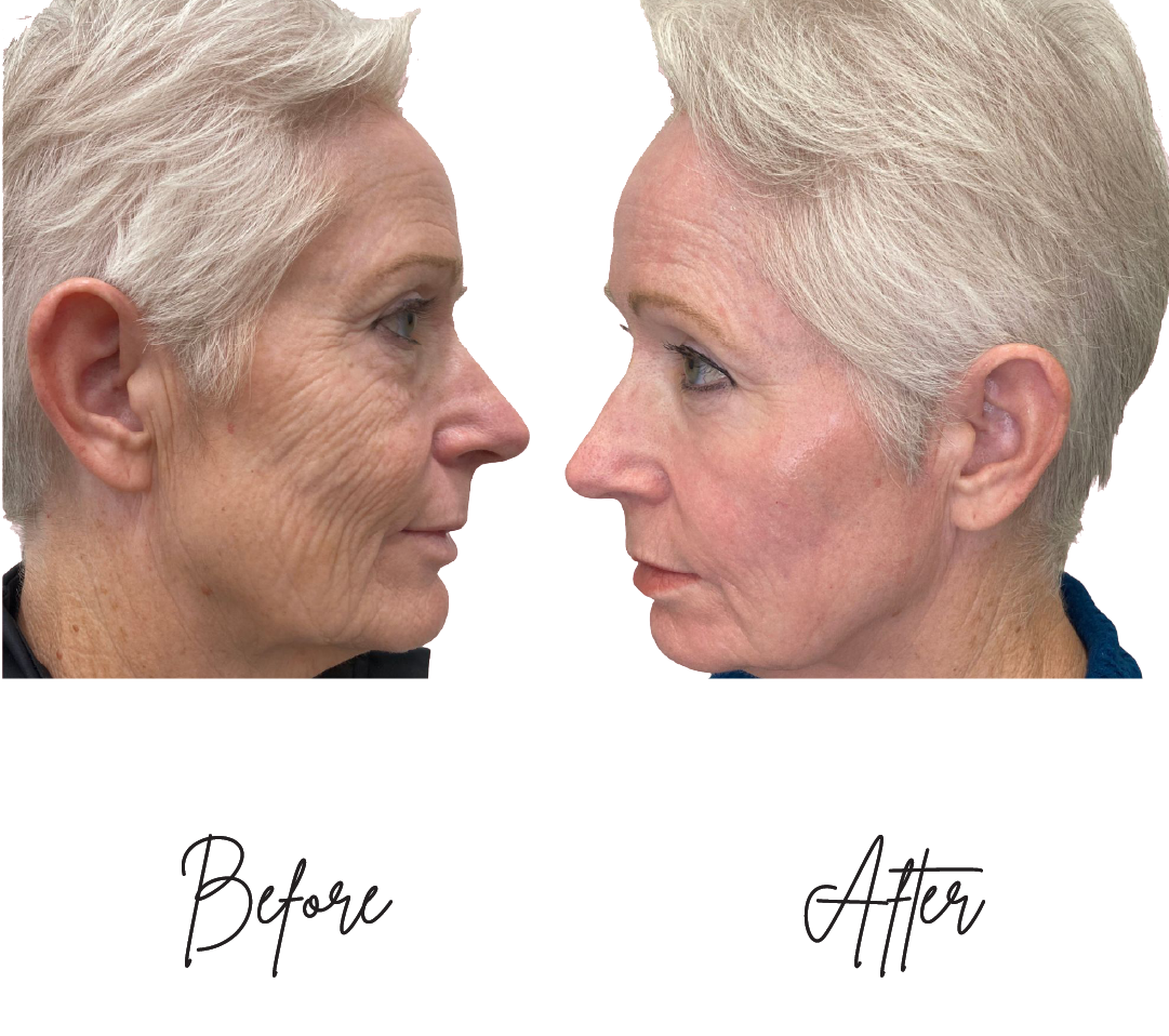 co2-laser-resurfacing-2