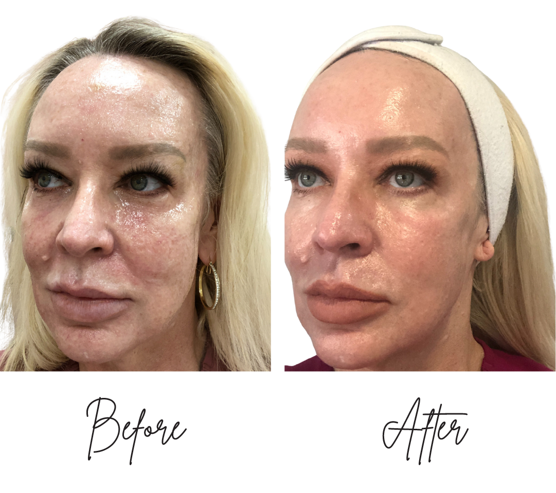 co2-laser-resurfacing-3