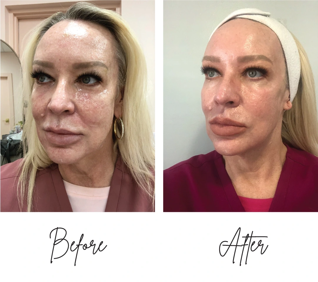 co2-laser-resurfacing five