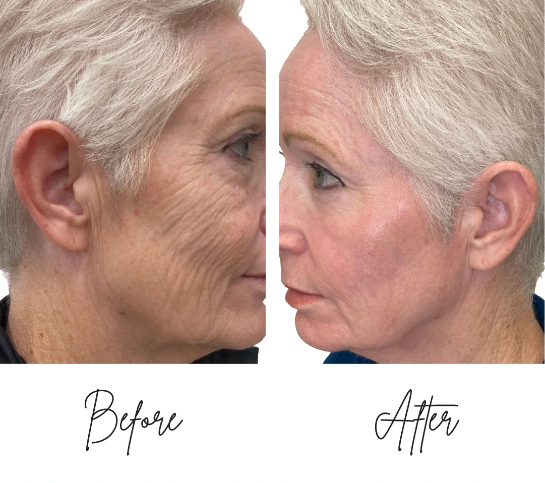 co2-laser-resurfacing four