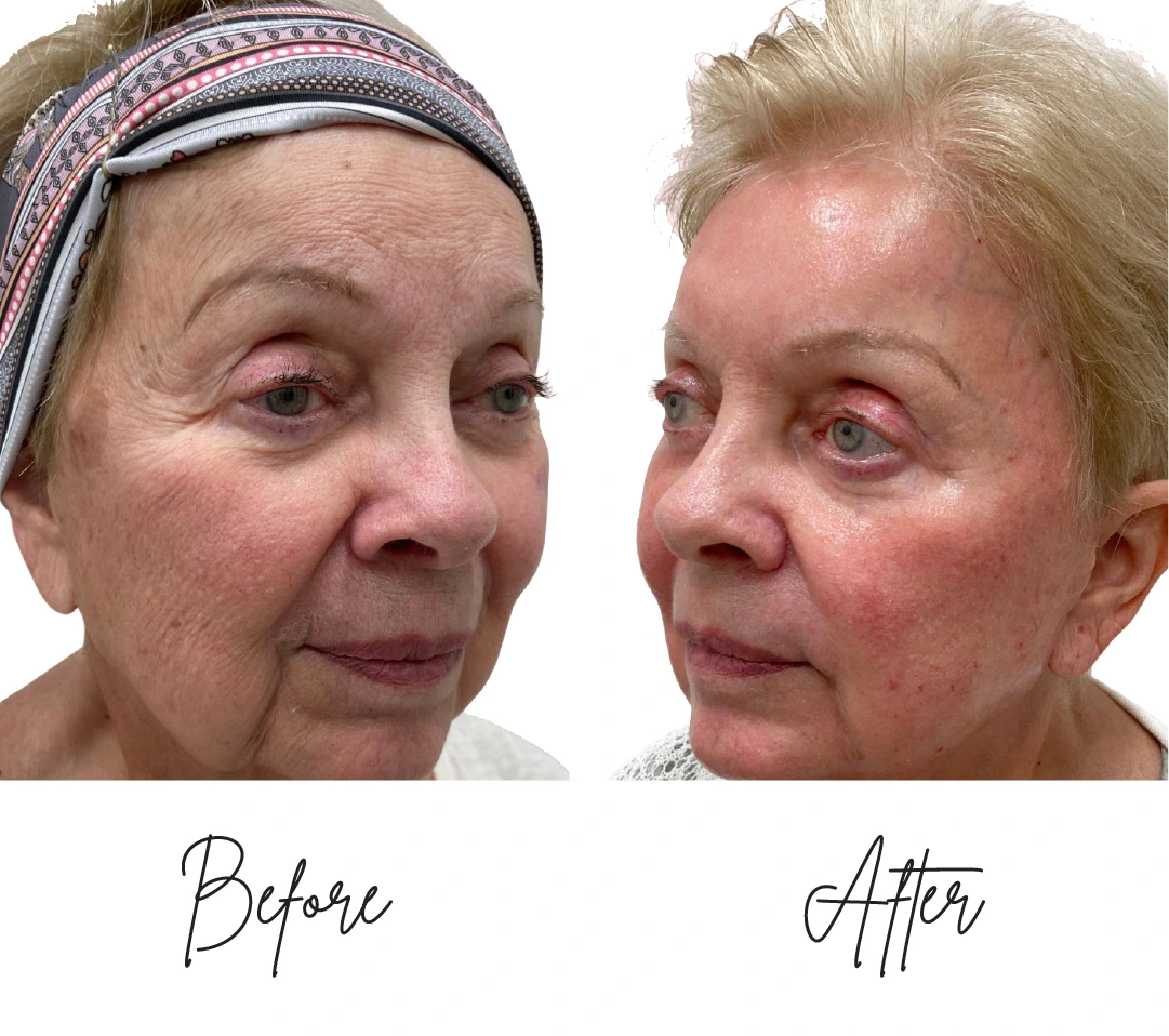 co2-laser-resurfacing one