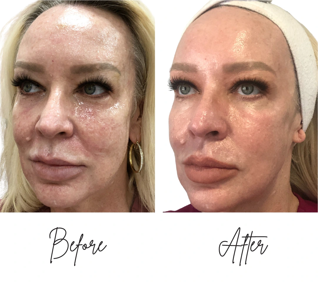 co2-laser-resurfacing three