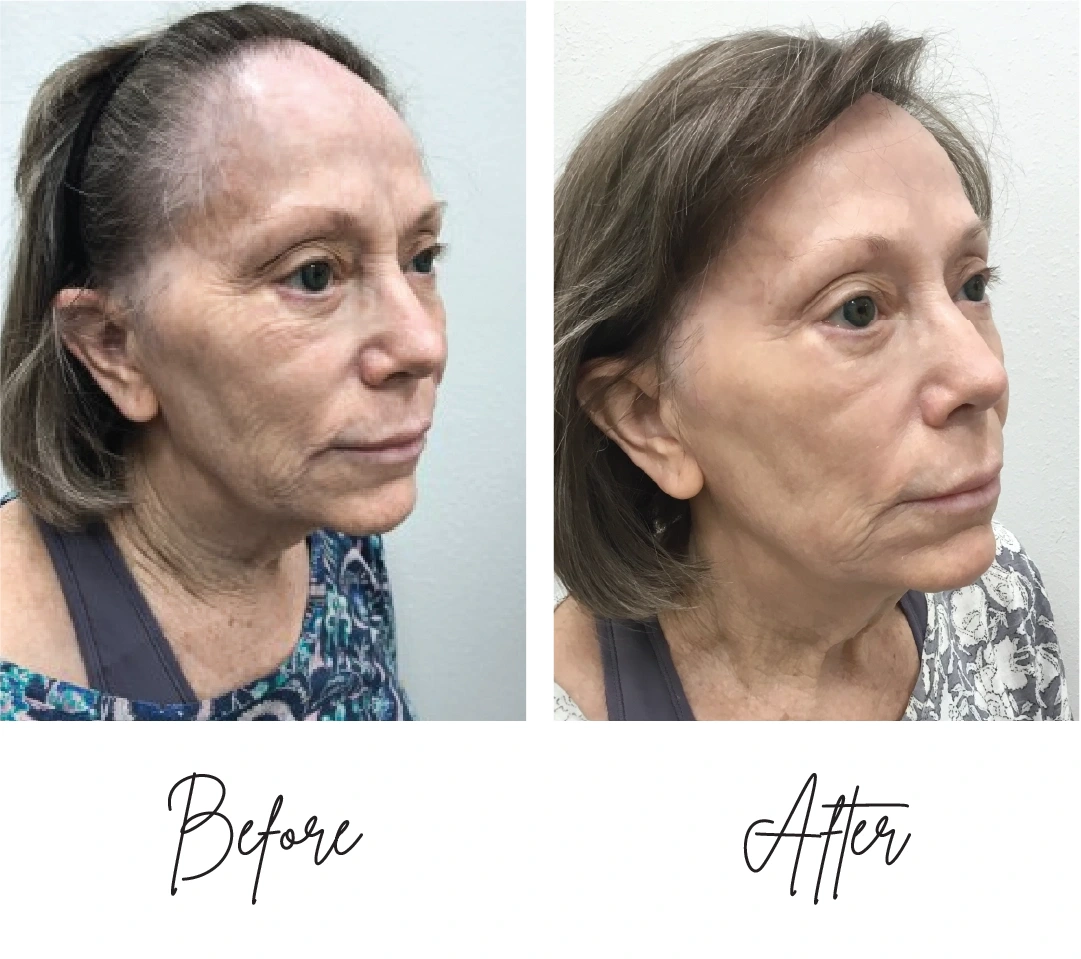 co2-laser-resurfacing two