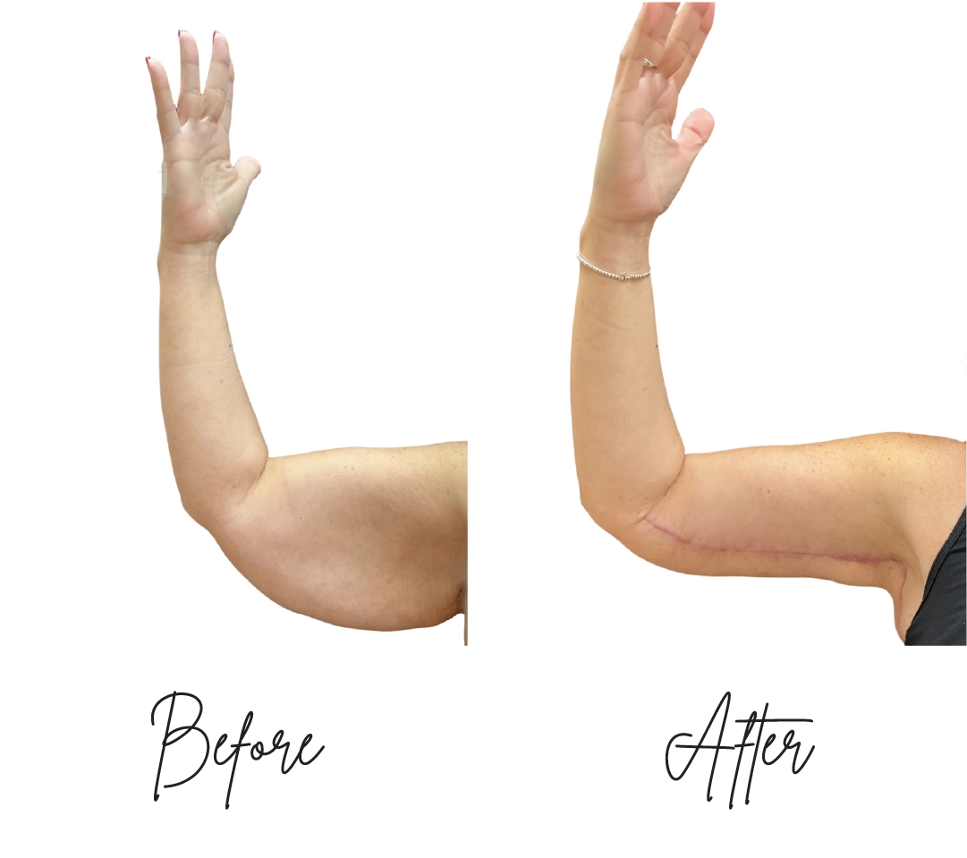 Brachioplasty Before After New