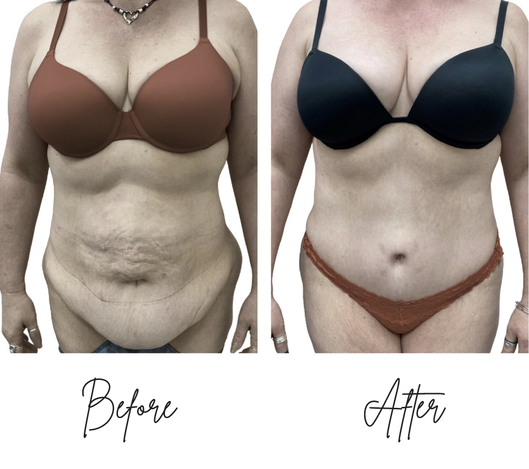 Tummy Tuck Before After (2)