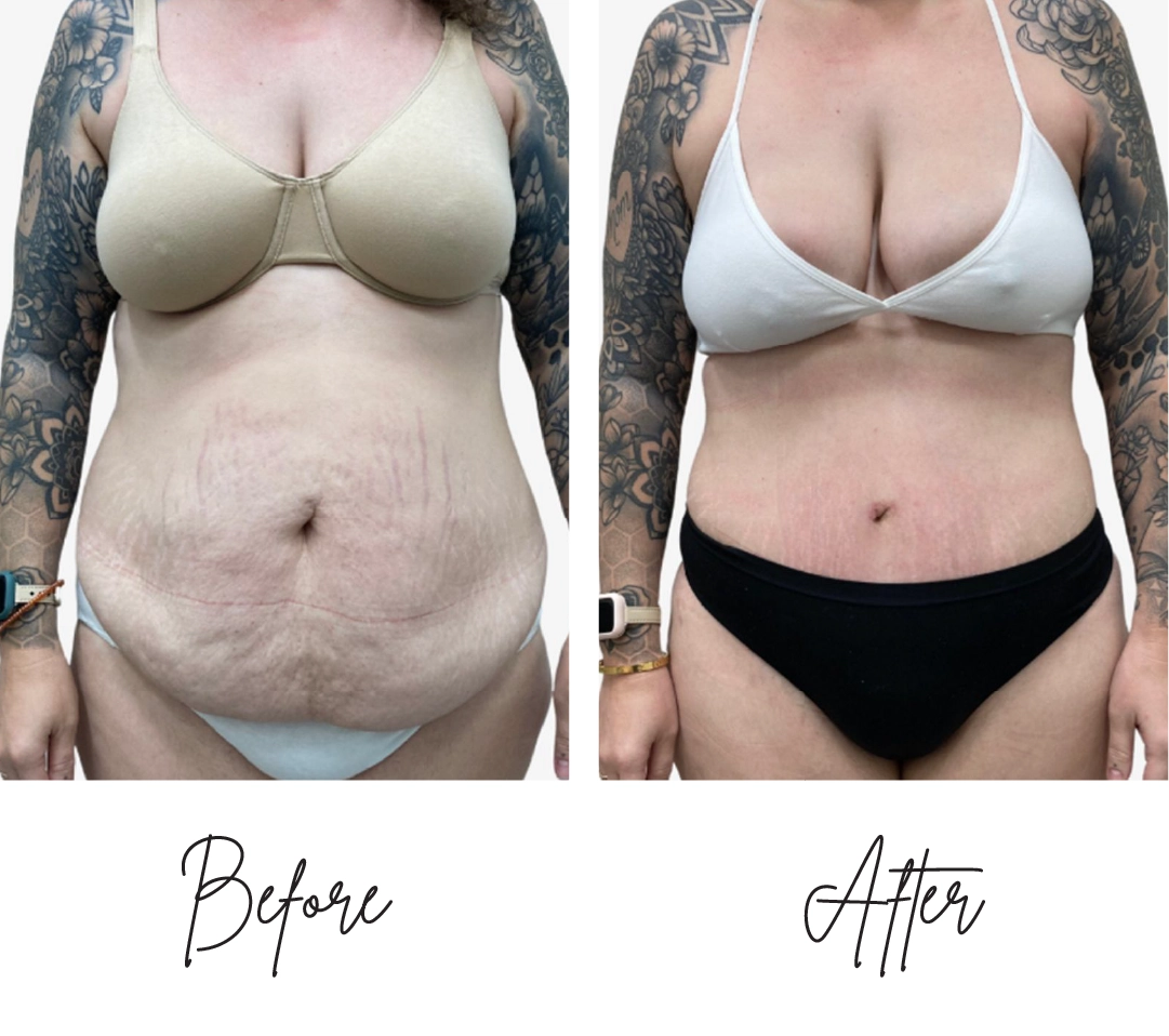 Tummy Tuck Before After (3)