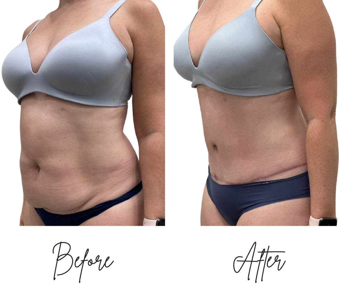 Tummy Tuck Before After (4)
