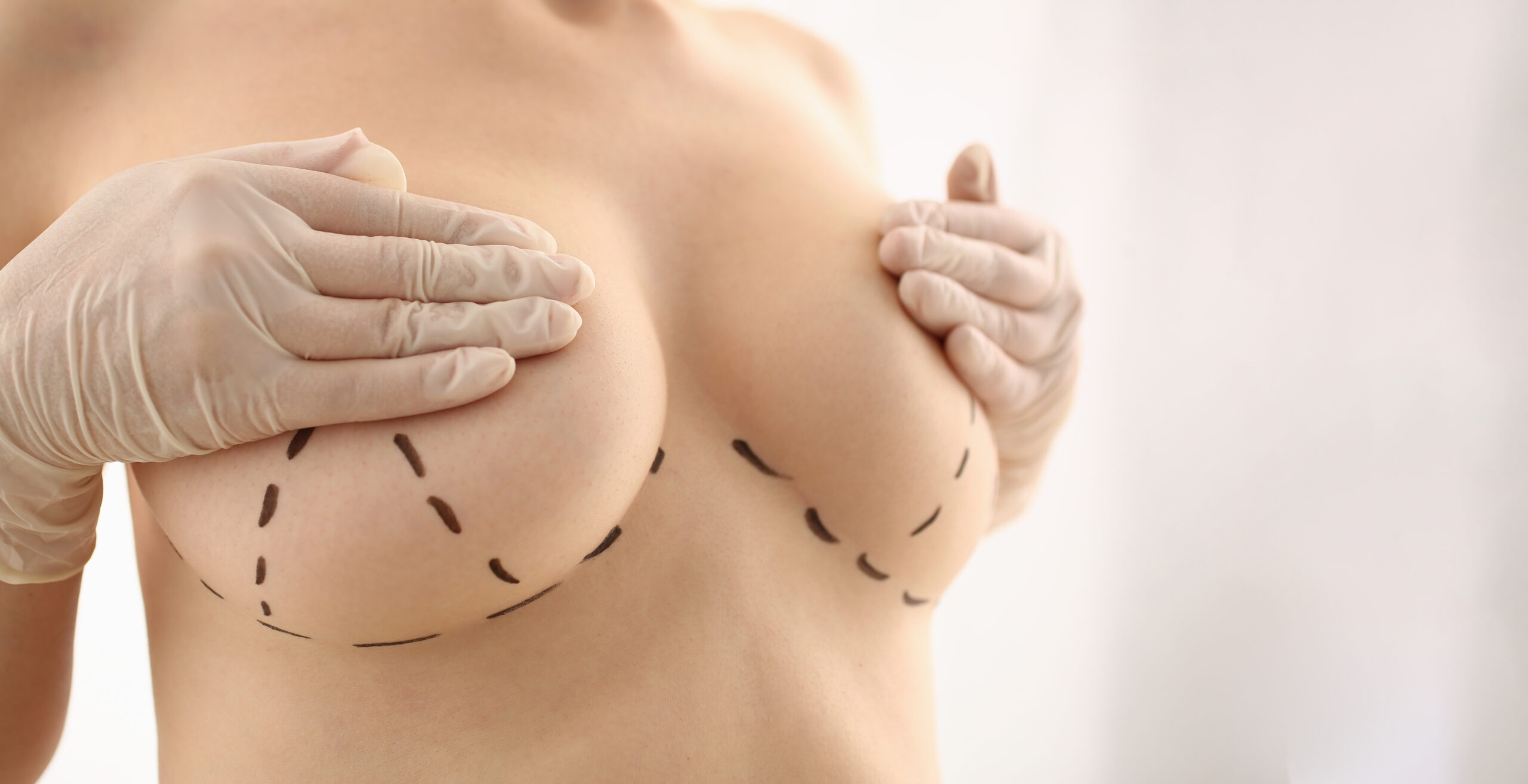 breast implant
